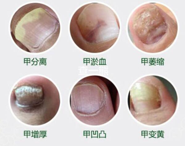 灰指甲的英文叫onychomycosis,主要是由真菌感染导致的,一般在脚上